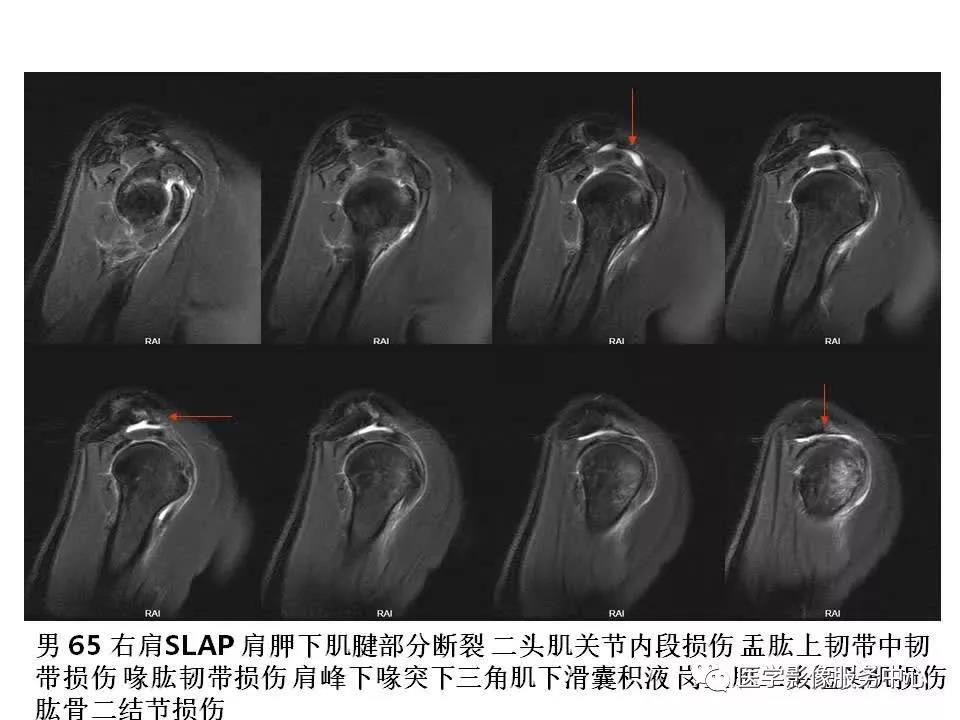 肩关节韧带及损伤的MR表现，都在这里了！