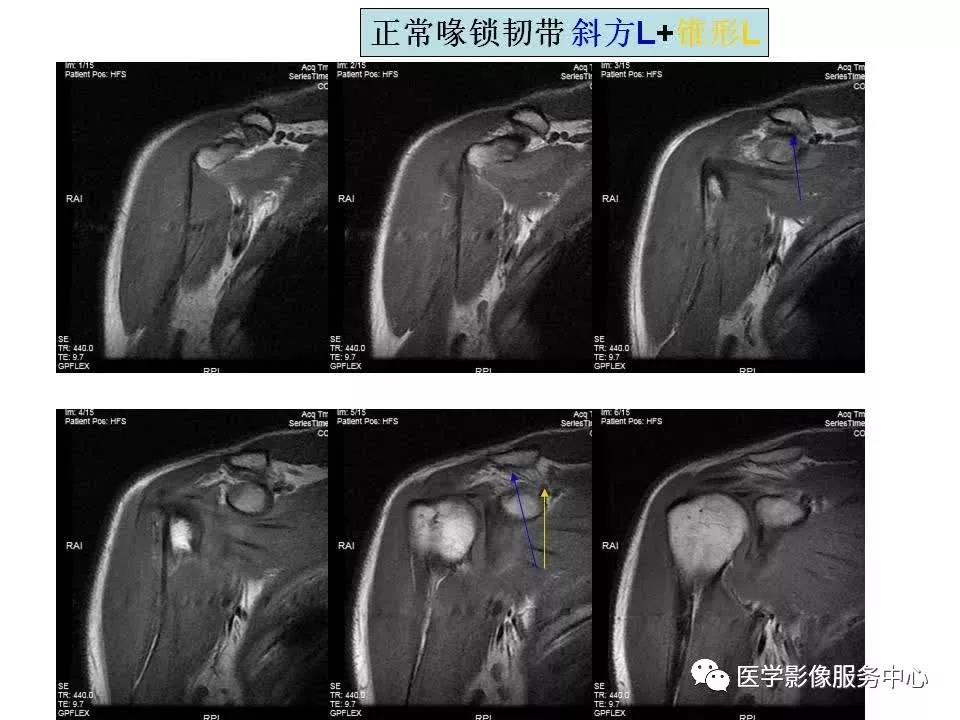 肩关节韧带及损伤的MR表现，都在这里了！