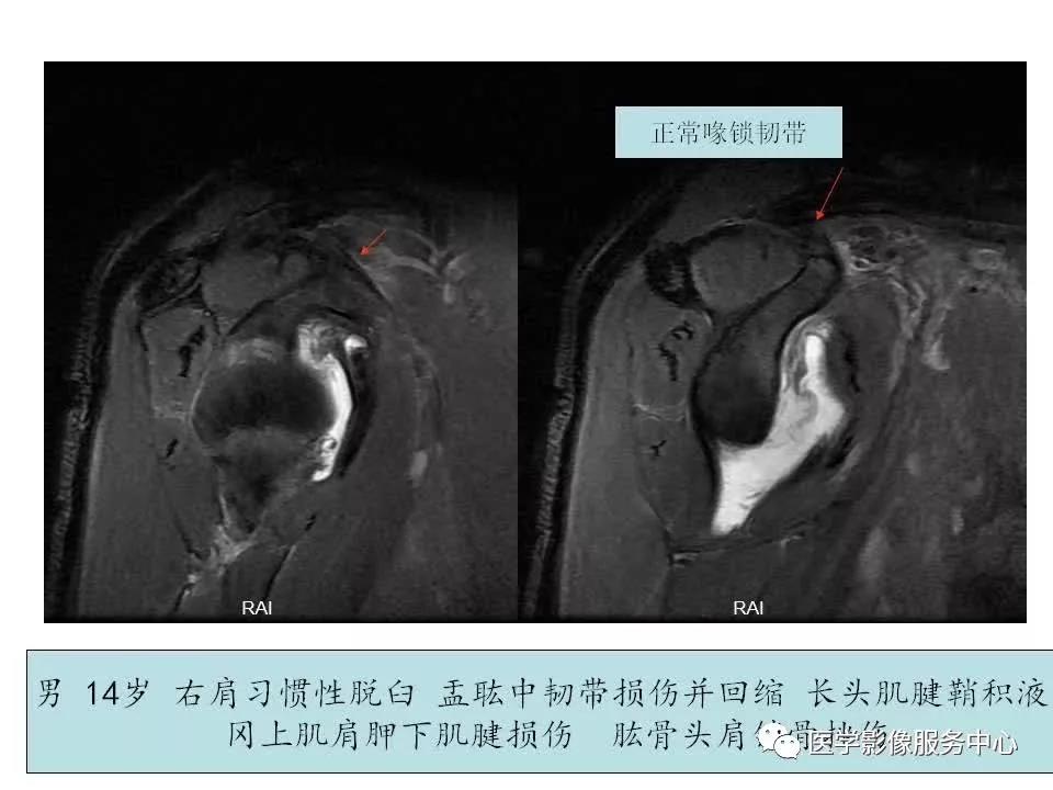 肩关节韧带及损伤的MR表现，都在这里了！