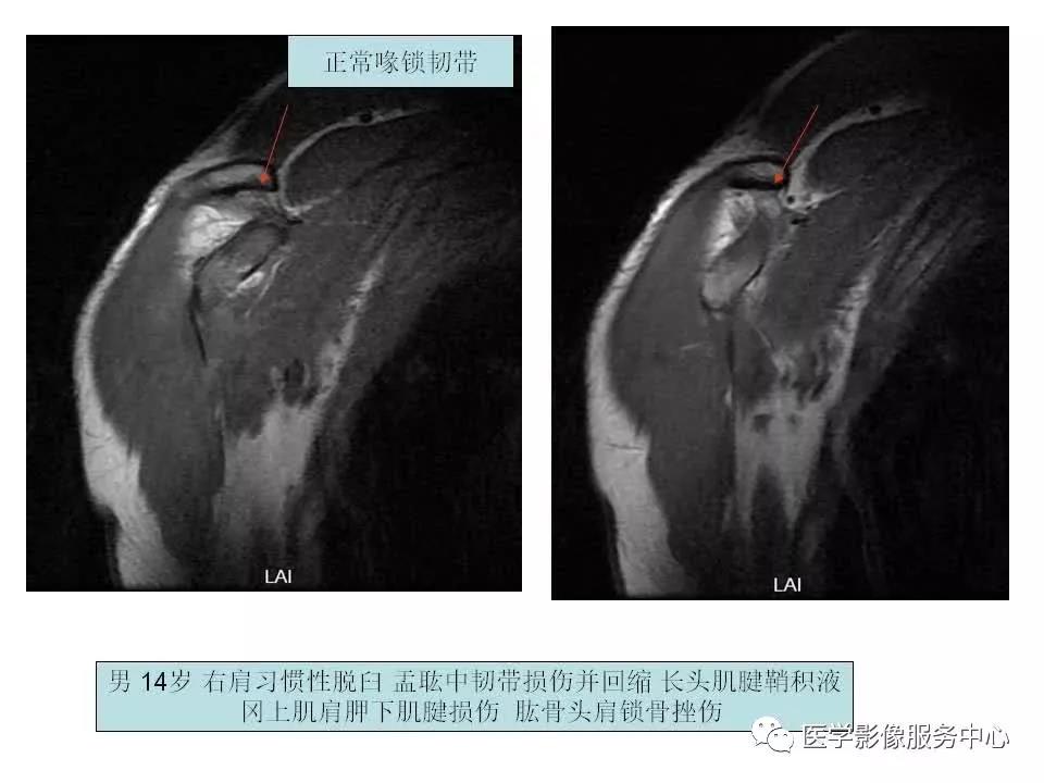 肩关节韧带及损伤的MR表现，都在这里了！