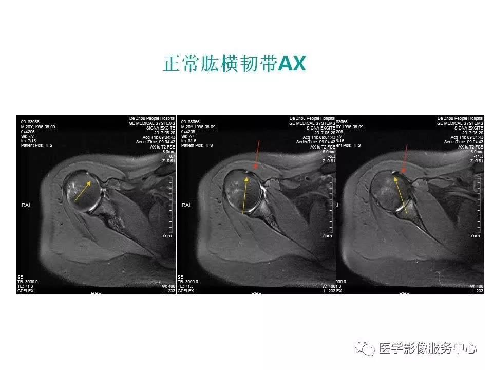 肩关节韧带及损伤的MR表现，都在这里了！