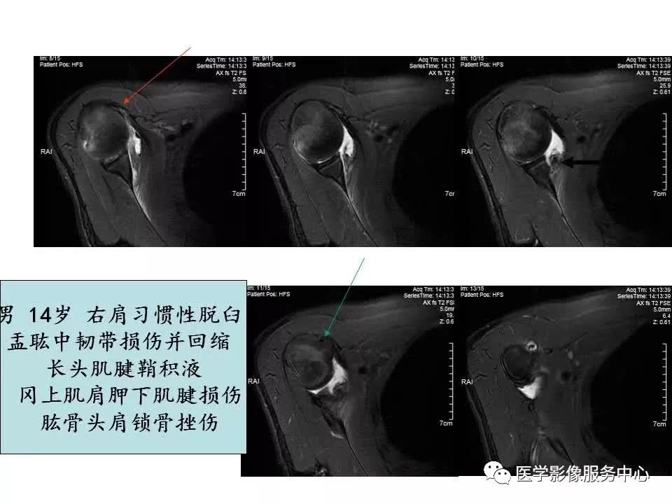 肩关节韧带及损伤的MR表现，都在这里了！