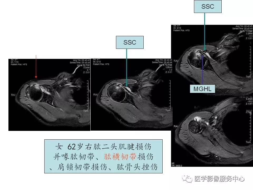 肩关节韧带及损伤的MR表现，都在这里了！