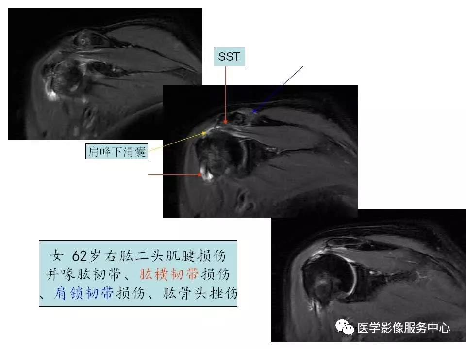 肩关节韧带及损伤的MR表现，都在这里了！