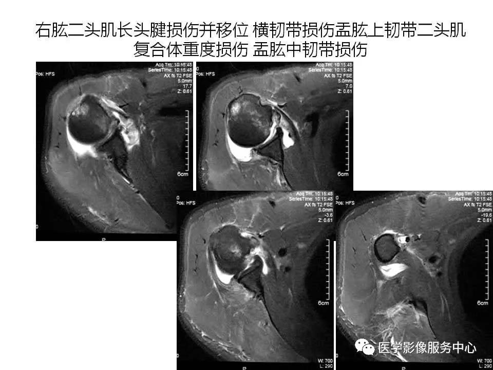 肩关节韧带及损伤的MR表现，都在这里了！