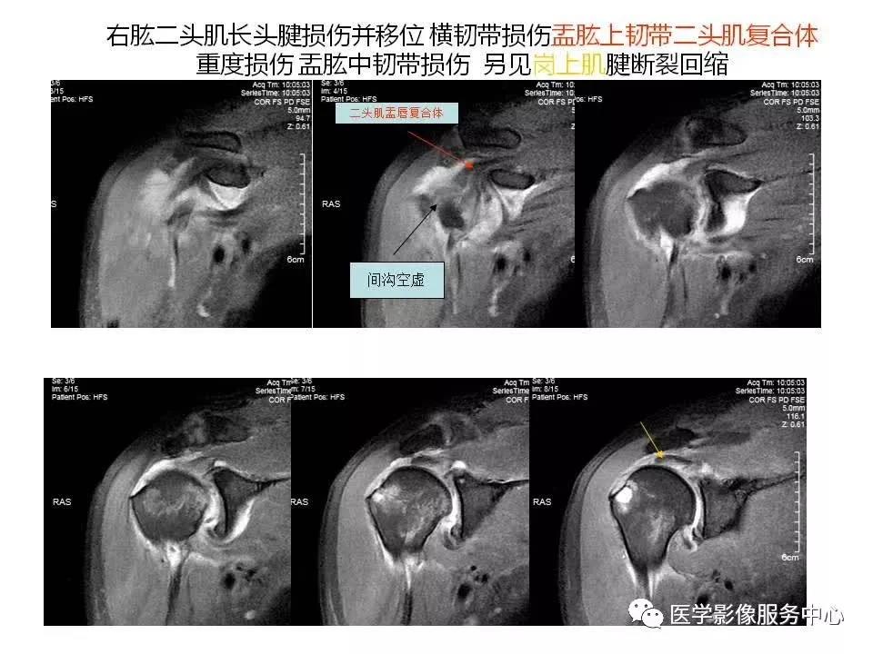 肩关节韧带及损伤的MR表现，都在这里了！