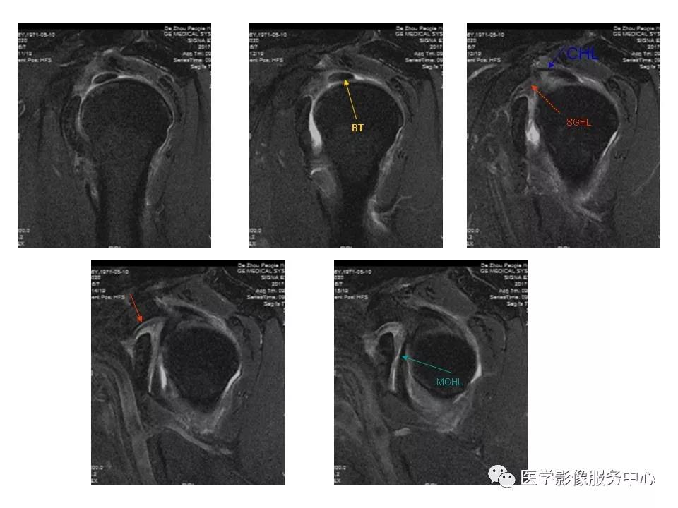 肩关节韧带及损伤的MR表现，都在这里了！