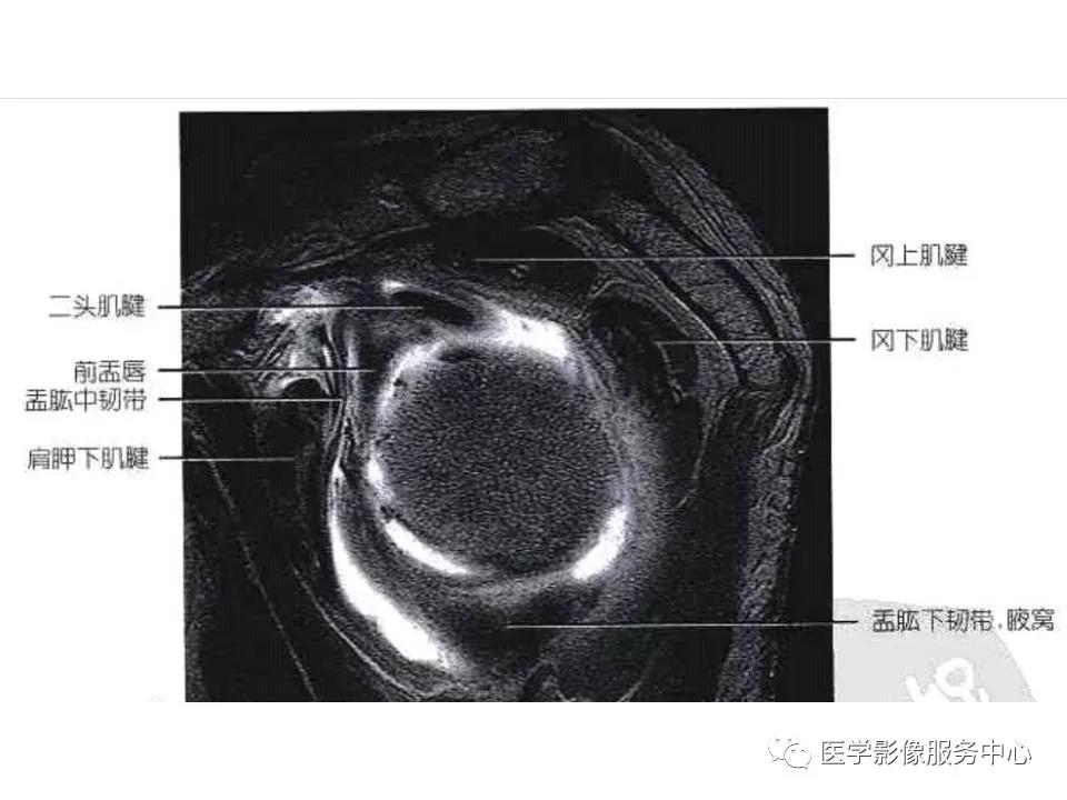 肩关节韧带及损伤的MR表现，都在这里了！