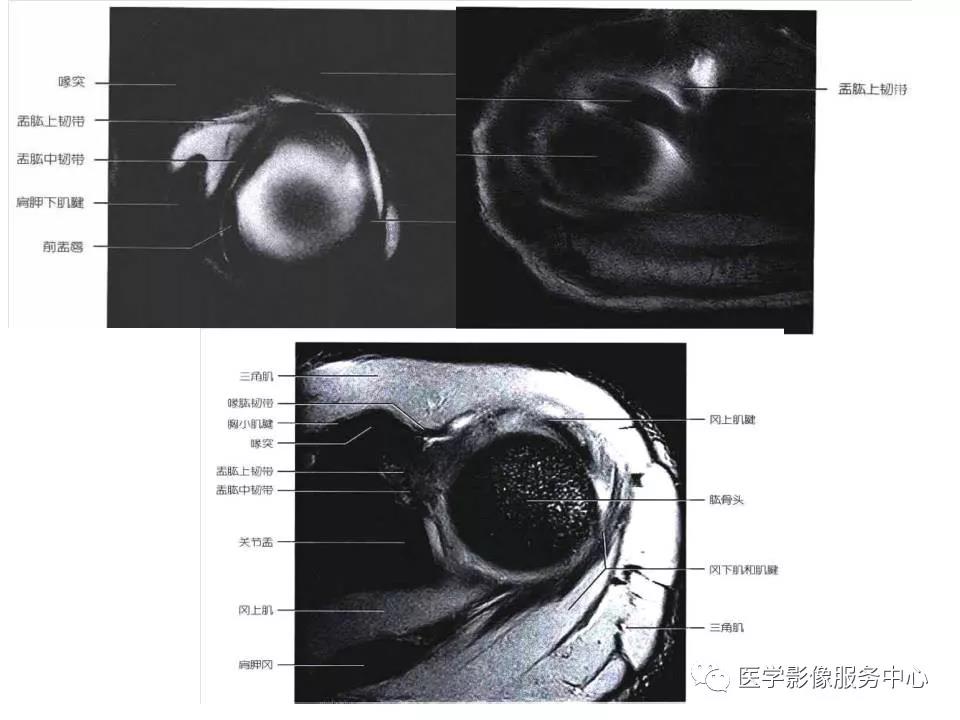 肩关节韧带及损伤的MR表现，都在这里了！