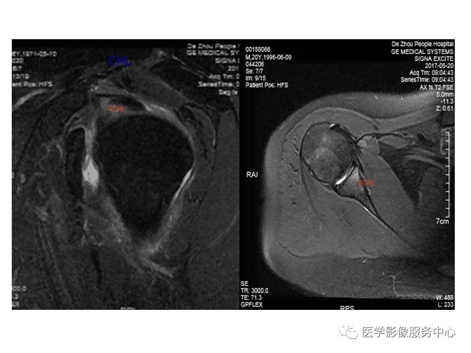 肩关节韧带及损伤的MR表现，都在这里了！