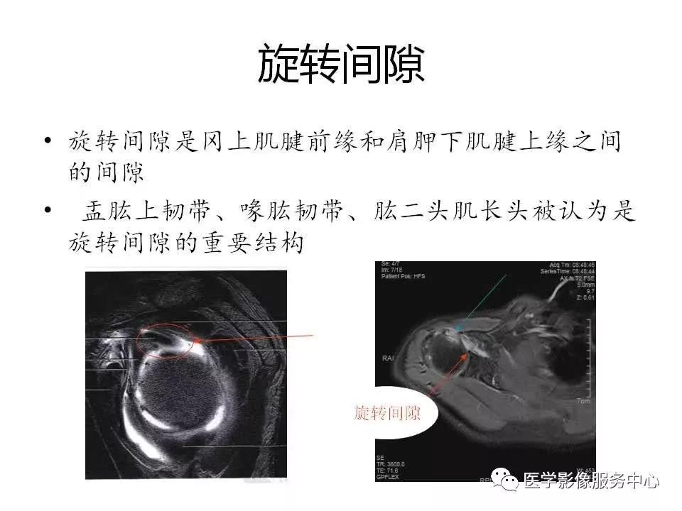 肩关节韧带及损伤的MR表现，都在这里了！