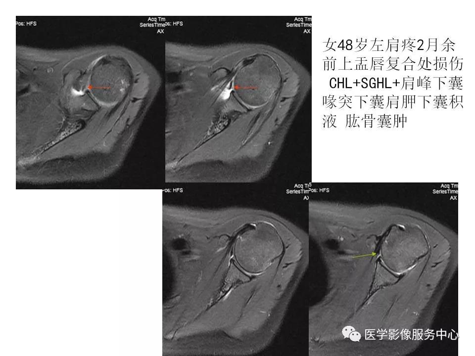 肩关节韧带及损伤的MR表现，都在这里了！