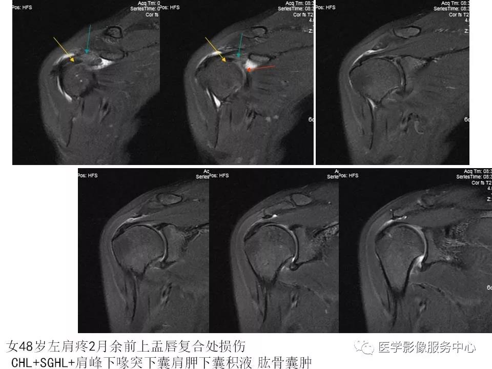 肩关节韧带及损伤的MR表现，都在这里了！