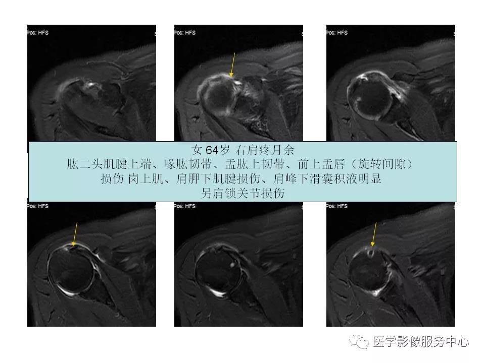 肩关节韧带及损伤的MR表现，都在这里了！