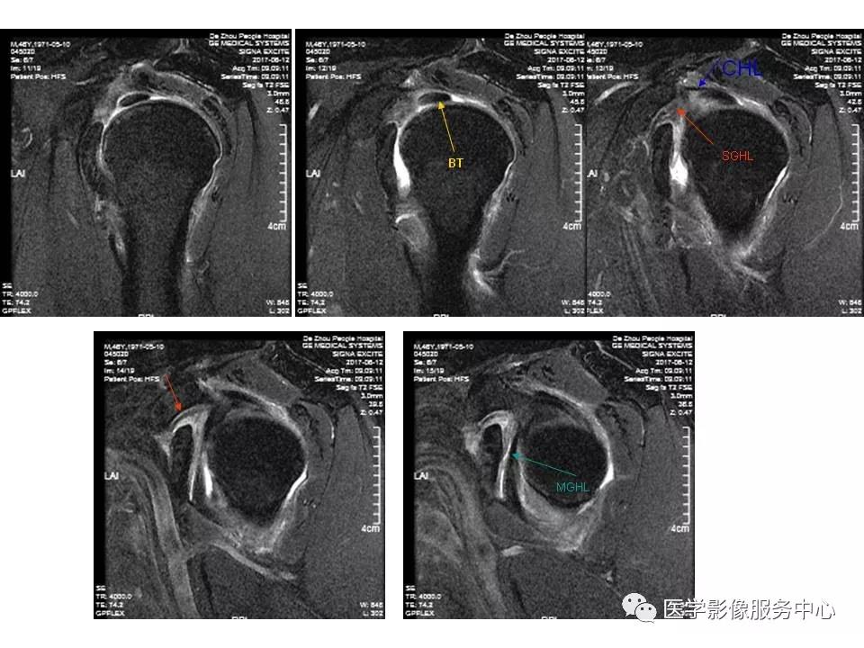 肩关节韧带及损伤的MR表现，都在这里了！