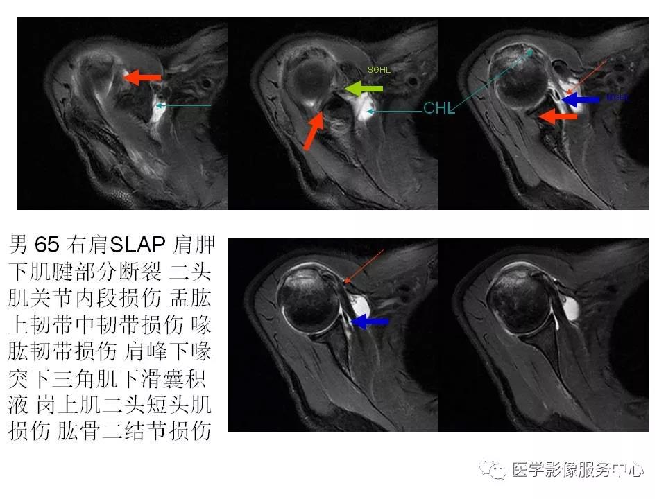 肩关节韧带及损伤的MR表现，都在这里了！