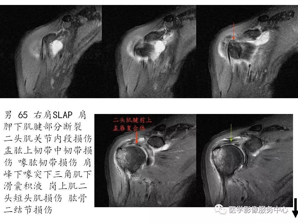 肩关节韧带及损伤的MR表现，都在这里了！