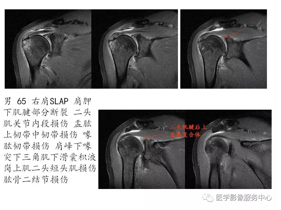 肩关节韧带及损伤的MR表现，都在这里了！