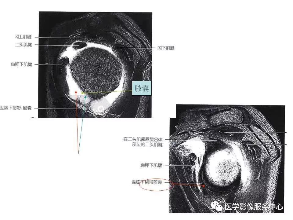 肩关节韧带及损伤的MR表现，都在这里了！