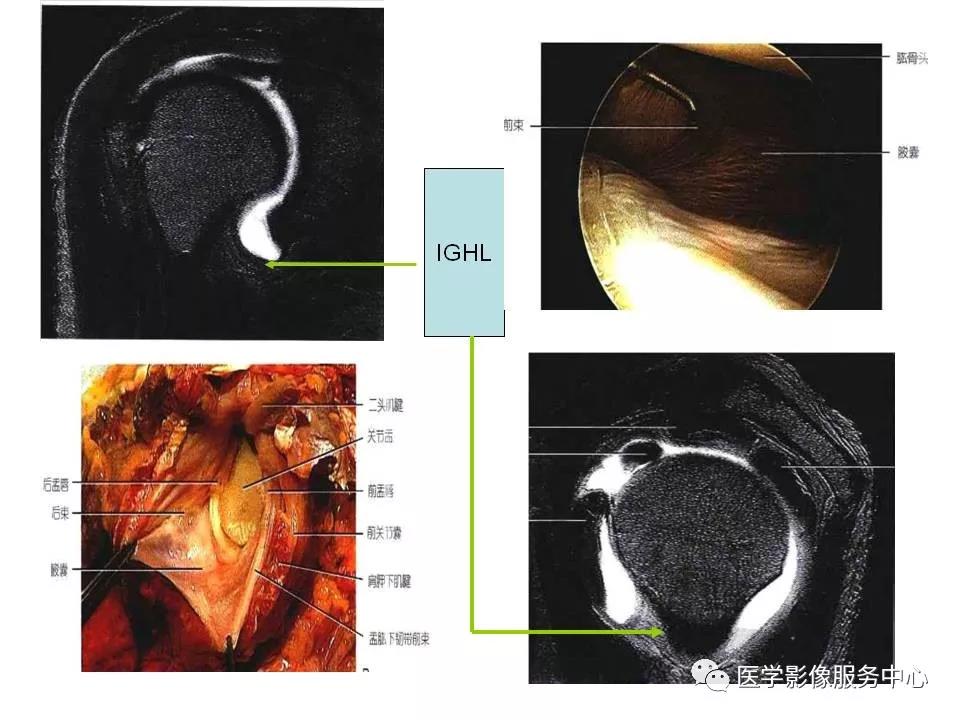 肩关节韧带及损伤的MR表现，都在这里了！