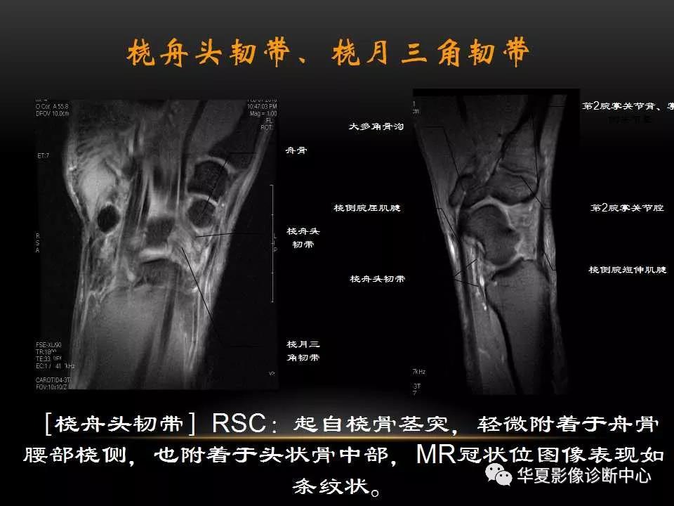 腕关节疾病的MRI诊断与解剖，看这篇就够了！