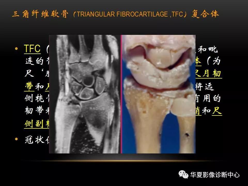 腕关节疾病的MRI诊断与解剖，看这篇就够了！