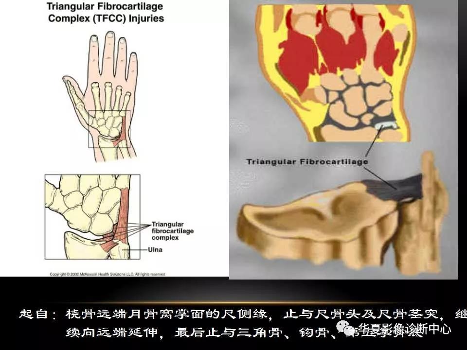 腕关节疾病的MRI诊断与解剖，看这篇就够了！