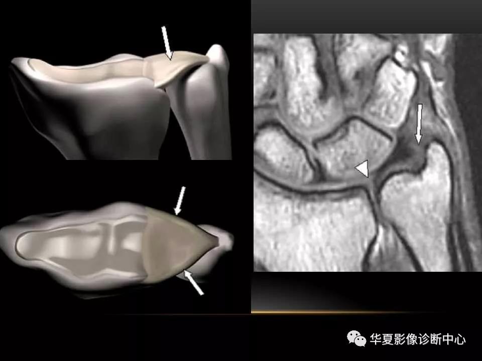 腕关节疾病的MRI诊断与解剖，看这篇就够了！