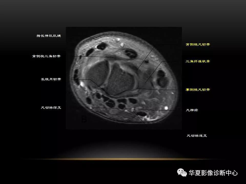 腕关节疾病的MRI诊断与解剖，看这篇就够了！