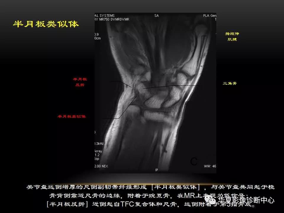 腕关节疾病的MRI诊断与解剖，看这篇就够了！