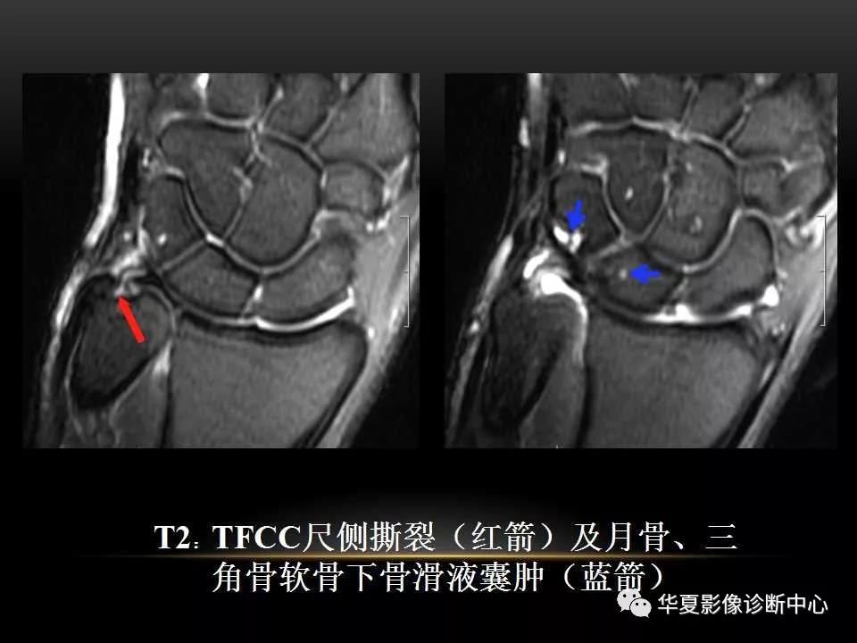 腕关节疾病的MRI诊断与解剖，看这篇就够了！