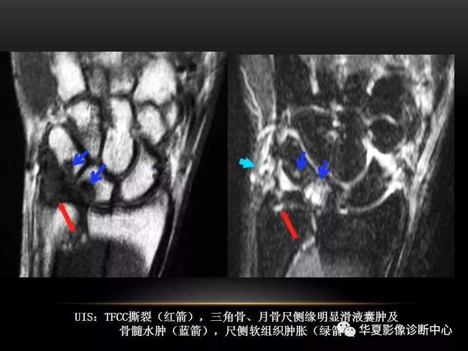 腕关节疾病的MRI诊断与解剖，看这篇就够了！