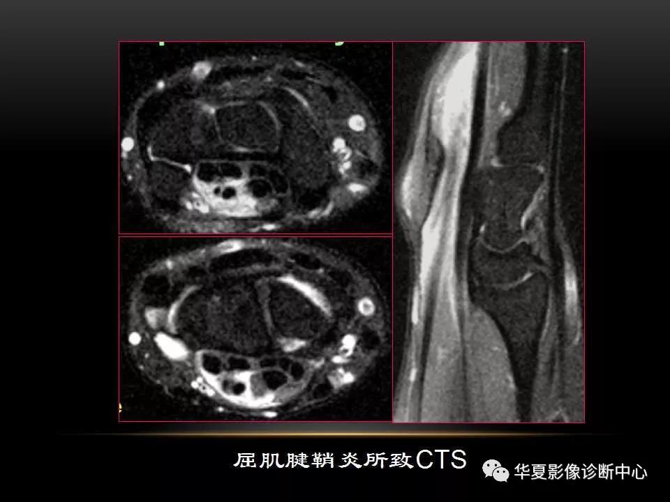 腕关节疾病的MRI诊断与解剖，看这篇就够了！