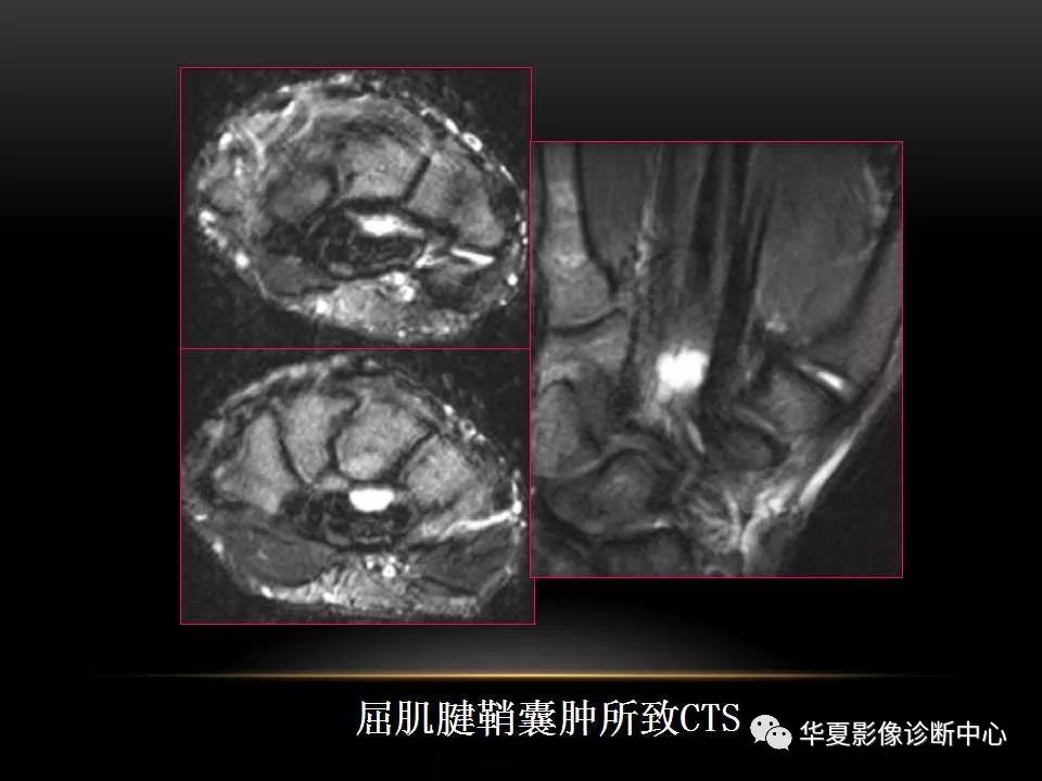 腕关节疾病的MRI诊断与解剖，看这篇就够了！