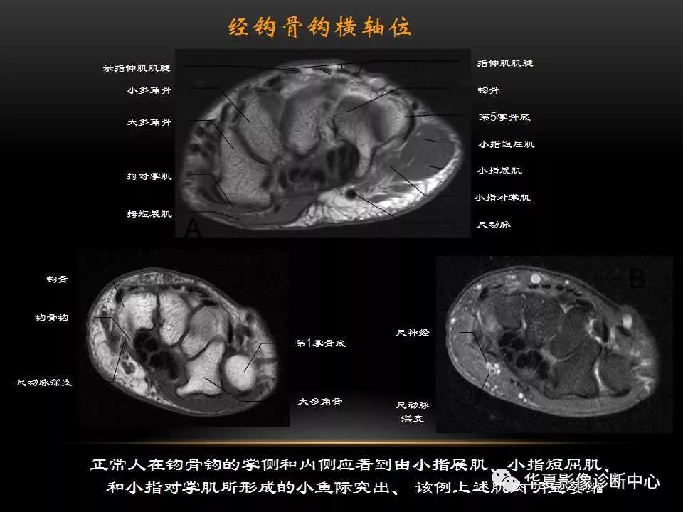 腕关节疾病的MRI诊断与解剖，看这篇就够了！