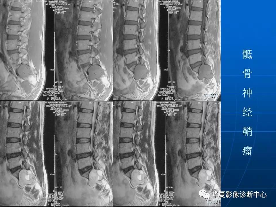 骶尾部脊索瘤如何进行影像诊断？一篇搞定！