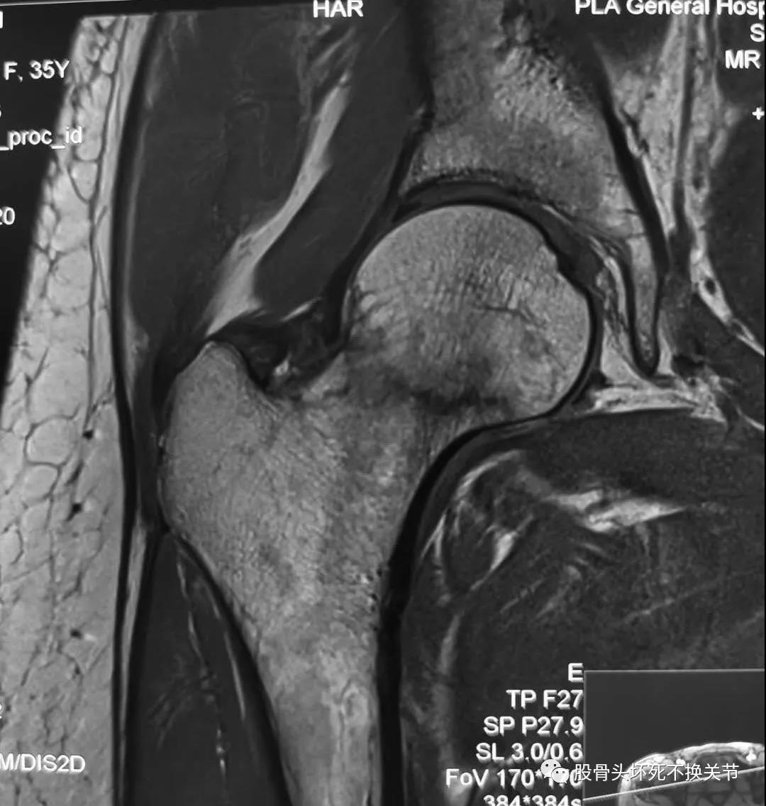 股骨颈疲劳性骨折/应力性骨折，你了解吗？