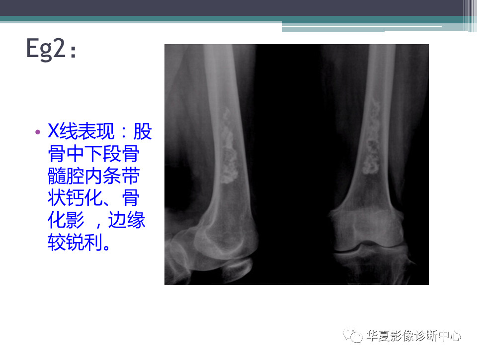 骨梗死的影像诊断，一篇搞定！
