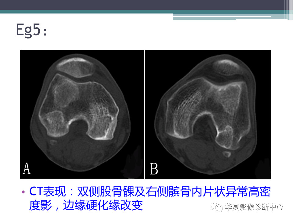 骨梗死的影像诊断，一篇搞定！