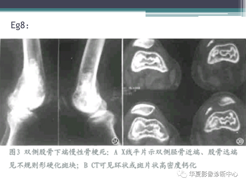 骨梗死的影像诊断，一篇搞定！