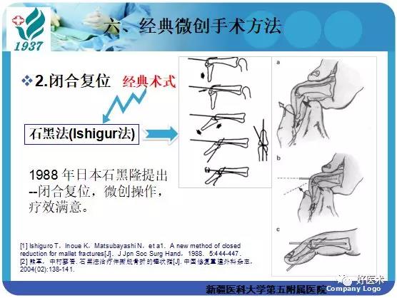 克氏针阻挡加压技术治疗骨性锤状指，全面讲解！