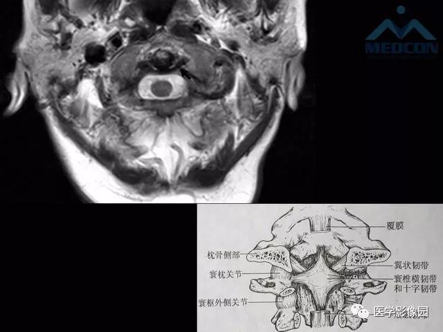 寰枢关节脱位的影像诊断