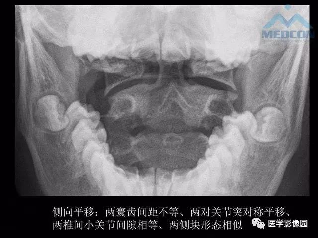 寰枢关节脱位的影像诊断