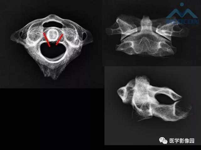 寰枢关节脱位的影像诊断