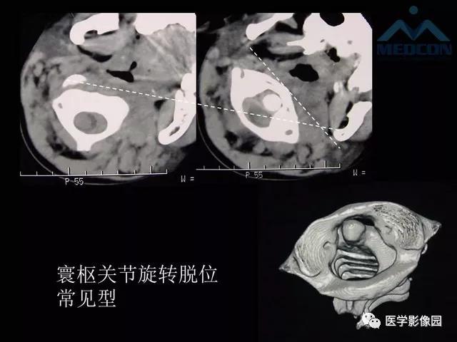 寰枢关节脱位的影像诊断