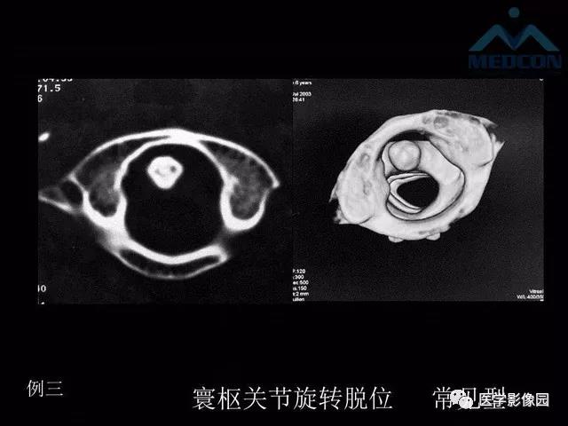 寰枢关节脱位的影像诊断