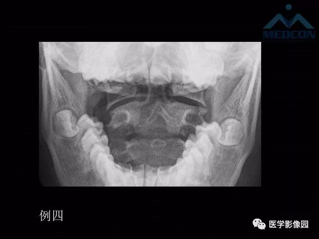 寰枢关节脱位的影像诊断