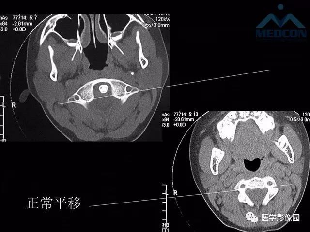 寰枢关节脱位的影像诊断