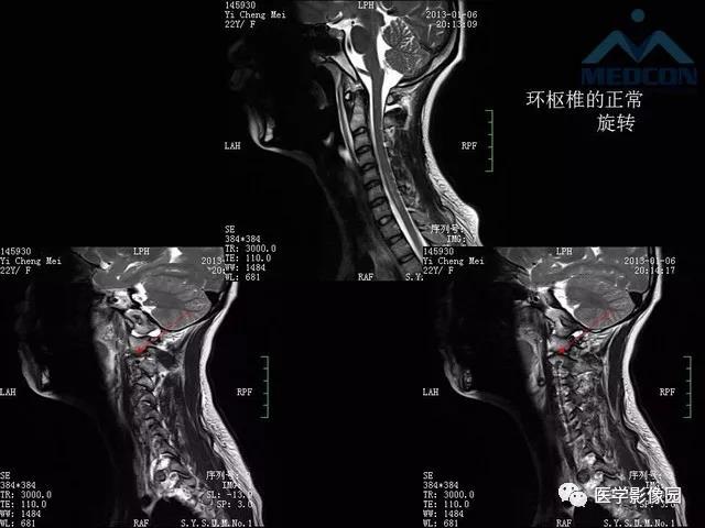 寰枢关节脱位的影像诊断