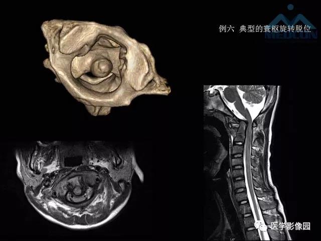 寰枢关节脱位的影像诊断
